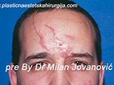 Before scar removal Before scar removal