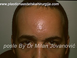 After scar removal After scar removal