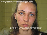 Before scar removal Before scar removal