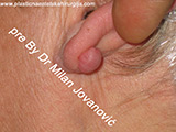 Before scar removal Before scar removal
