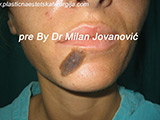 Before scar removal Before scar removal