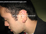 Before scar removal Before scar removal