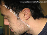 After scar removal After scar removal