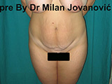 Before tummy tuck Before tummy tuck