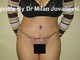 After tummy tuck After tummy tuck