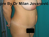 Before tummy tuck Before tummy tuck