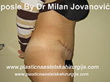 After tummy tuck After tummy tuck
