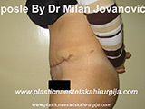 After tummy tuck After tummy tuck