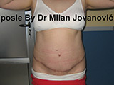 After tummy tuck After tummy tuck