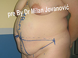 Before tummy tuck Before tummy tuck