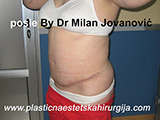 After tummy tuck After tummy tuck