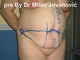 Before tummy tuck Before tummy tuck