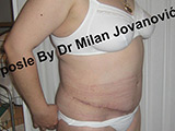After tummy tuck After tummy tuck