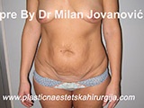Before tummy tuck Before tummy tuck