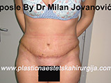 After tummy tuck After tummy tuck