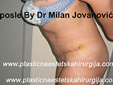 After tummy tuck After tummy tuck