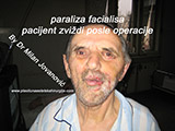 After the plastic surgery After the plastic surgery