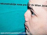 Before the plastic surgery Before the plastic surgery