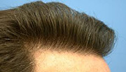 Hair Transplantation